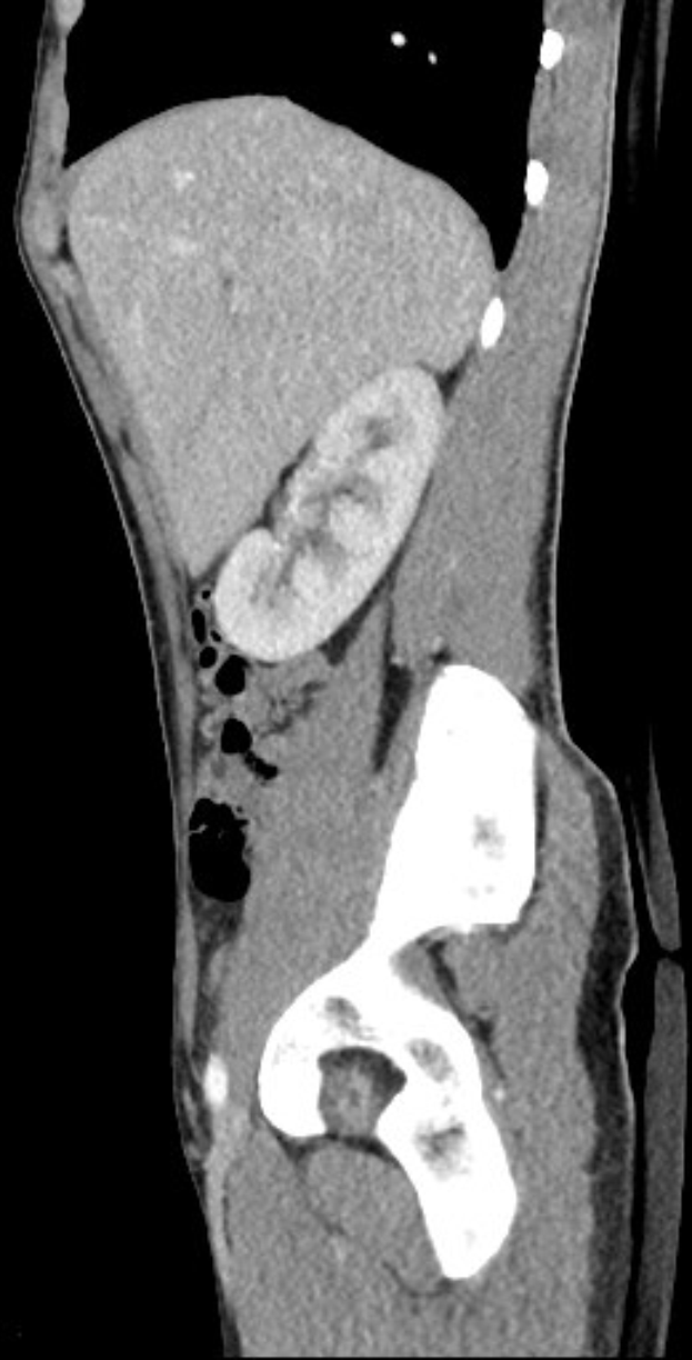Schwarß-weißer MRI-Aufnahme eines Kniegelenks mit detaillierter Anatomie.