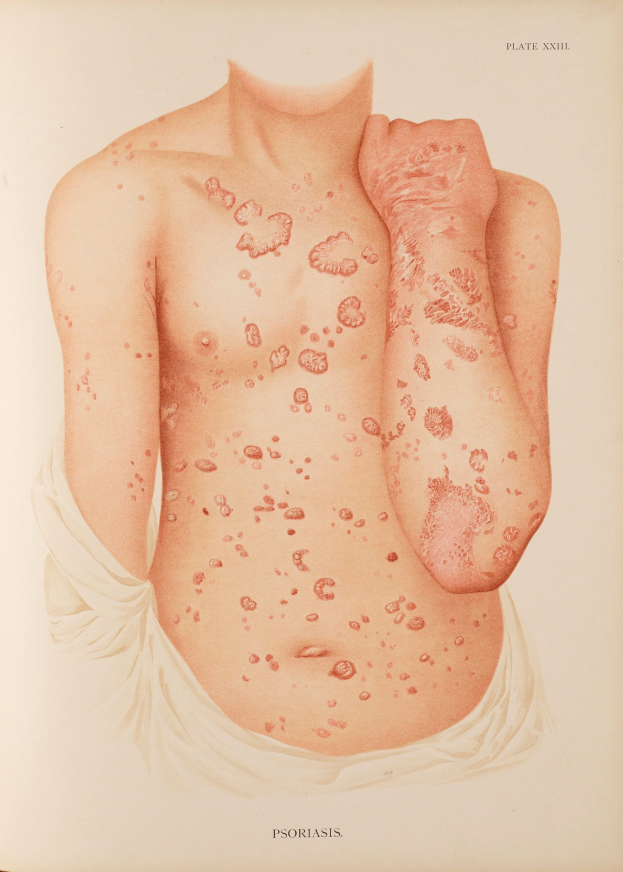 Ein Buchumschlag mit einer Illustration eines Mannes mit roten Flecken, die wahrscheinlich Psoriasis darstellen, neben einem Text über die Erkrankung.